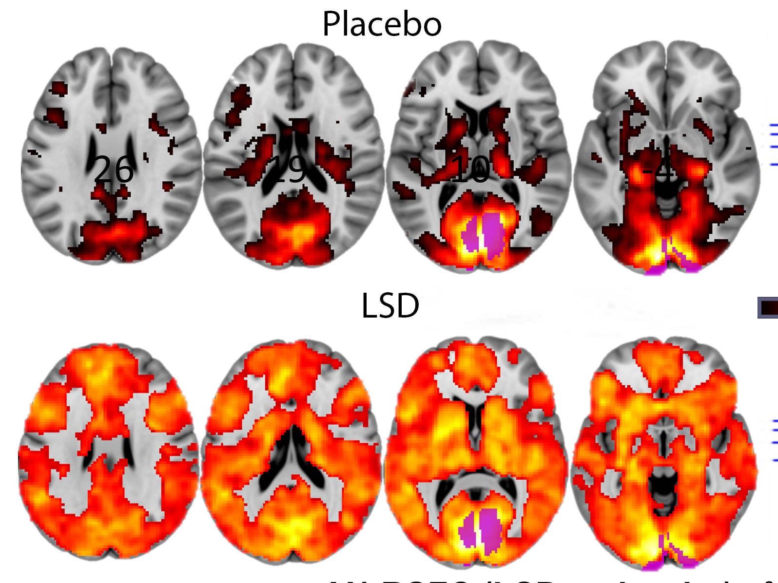 lsd vs placebo